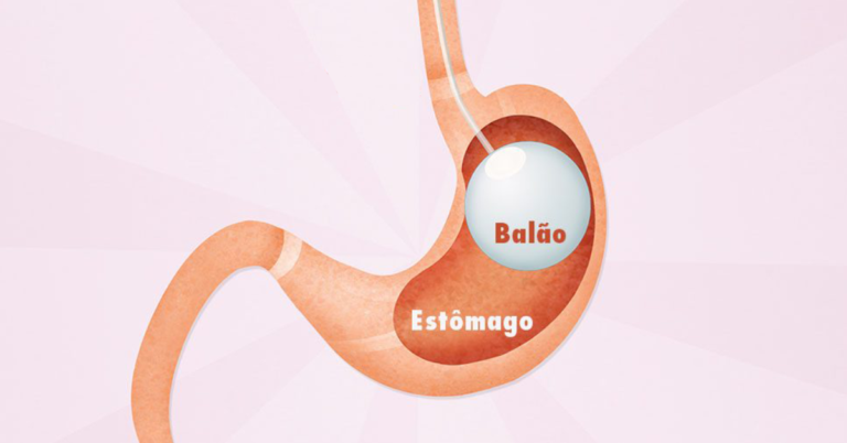 Balão intragástrico